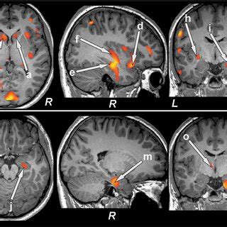 Brain Regions With Reduced Gray Matter Volume In T2DM Patients Over