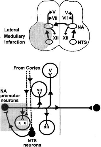 Dysphagia in Lateral Medullary Infarction (Wallenberg’s Syndrome) | Stroke