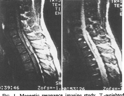 Figure 1 From Myelopathy Due To Epidural Varicose Veins Of The