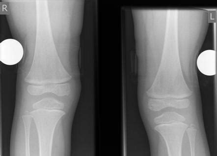 Nail Patella Syndrome Knee