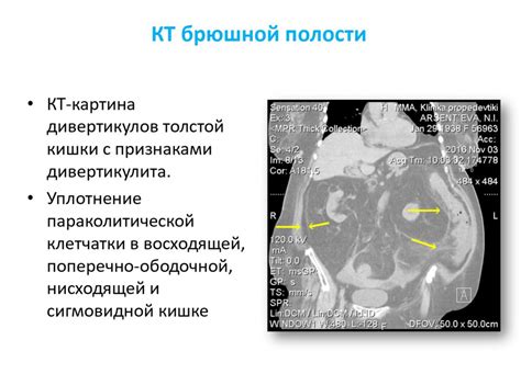 Дивертикулит Сигмовидной Кишки Питание Диета После Операции — Похудение ...
