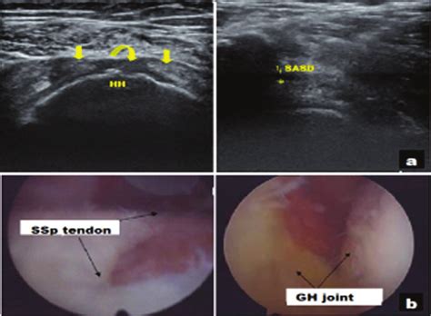 Ultrasonographic Image Of Rotator Cuff Tear Download Scientific Diagram