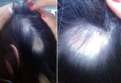 Wen Hair Care Lawsuit: See Photos of Hair Loss