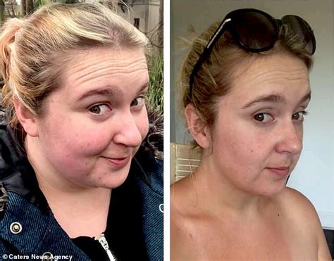 Woman raising £17K to have excess skin removed after 12st weightloss - Worldlifestylenews.com