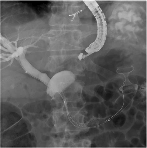 Same Session Double Eus Guided Bypass Versus Surgical Gastroenterostomy