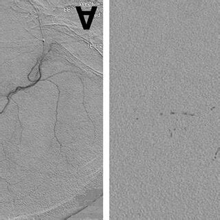 A: Superselective angiogram of the right middle meningeal artery... | Download Scientific Diagram