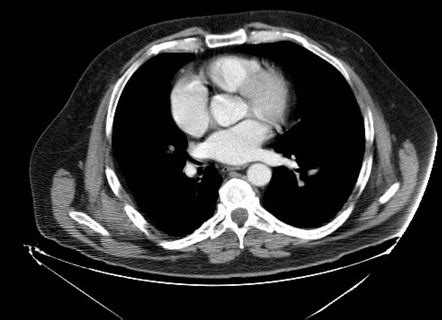 Bilateral Elastofibroma Dorsi Radiology Case Radiopaedia Org