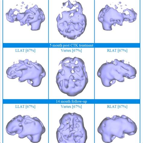 | Brain SPECT images for Patient VI. Top line relates to brain SPECT ...