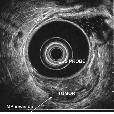 Eus Staging Cancer