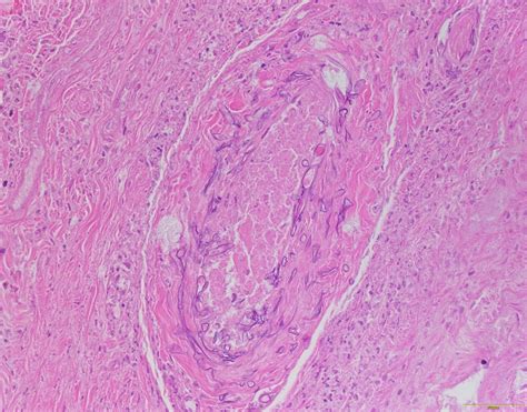 Qiaos Pathology Nasal Mucormycosis Zygomycosis A Photo On Flickriver