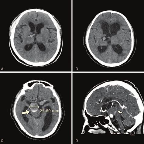 Pdf Severe Vertebrobasilar Dolichoectasia As A Cause Of Obstructive