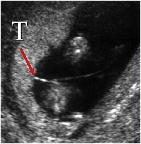 Guideline No 428 Management Of Dichorionic Twin Pregnancies Journal