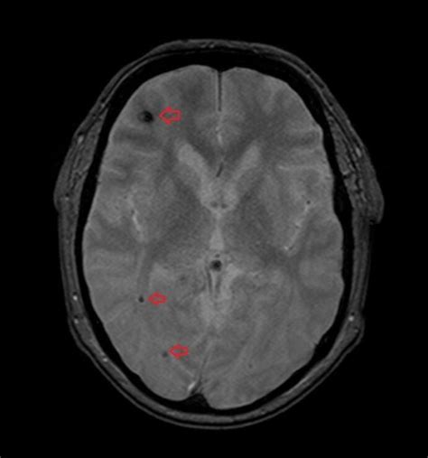 Blooming Artifact Mri