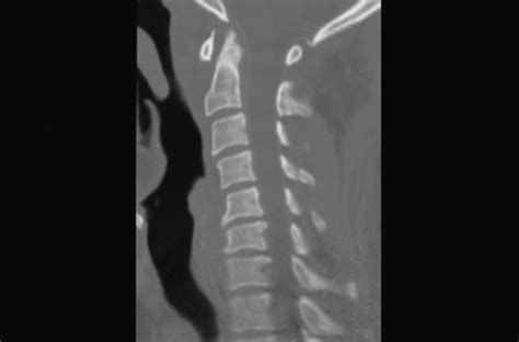 C Spine Injuries Ct Interpretation Core Em