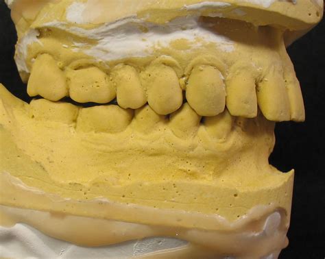 Bite Splint – FTI Dental Lab