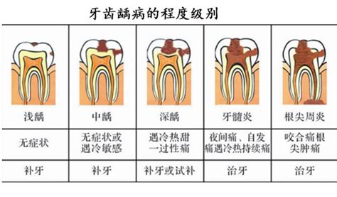 为什么会得虫牙蛀牙？虫牙蛀牙的原因及解决办法 知乎