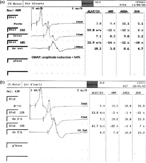 A Ulnar Nerve Motor Conduction In The First Evaluation Of A Patient