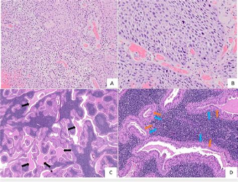 Photomicrographs Show A And B Sheets Of Moderately Differentiated