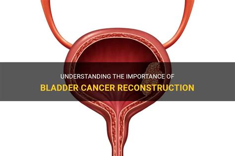 Understanding The Importance Of Bladder Cancer Reconstruction Medshun