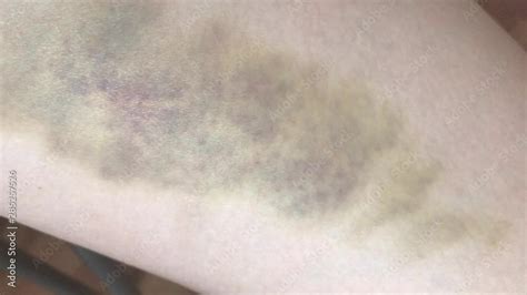 Video Close Up Of A Large Bruise And Hematoma On The Skin Of The Hip Of A Woman The Concept Of