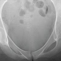 A 20-year-old woman with severe acetabular dysplasia. (a) Preoperative ...