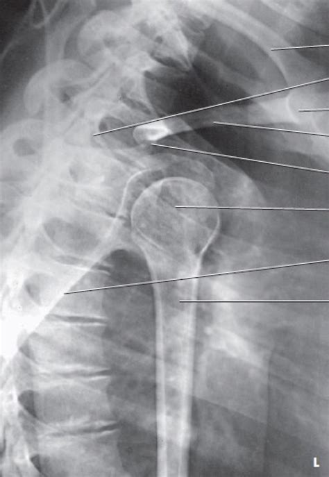 Transthoracic Lateral Projection Lawrence Method Diagram Quizlet