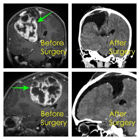 Paediatric Brain Surgery Johannesburg