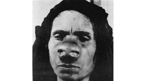 15 Tragic Facial Deformities - Gallery | eBaum's World