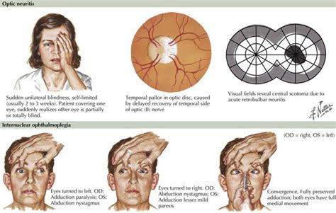 Multiple Sclerosis Neupsy Key