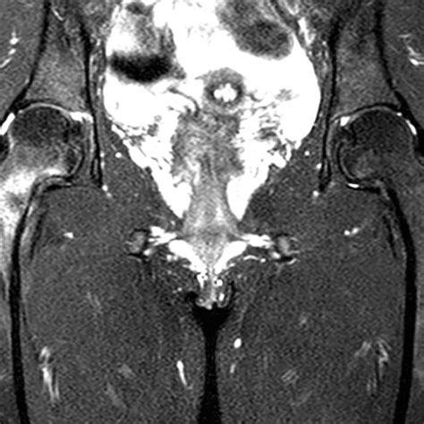 Pdf Management Of Femoral Neck Stress Fracture In An Athlete Using