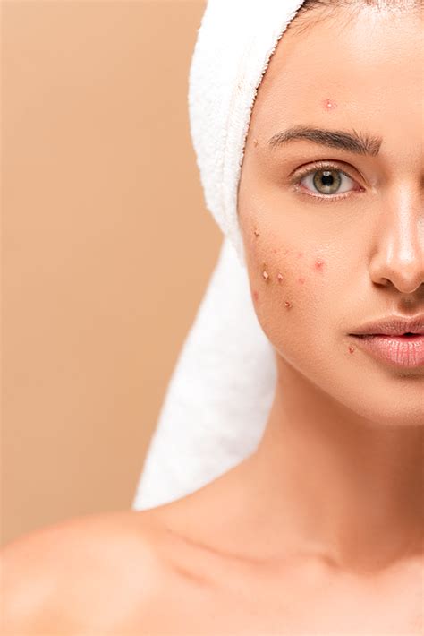 유토이미지 cropped view of naked girl in towel with acne on face isolated