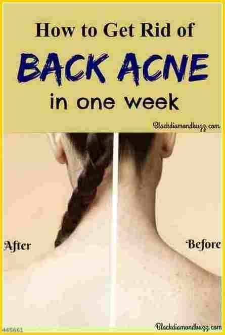 Natural Diy Back Acne Remedy 11 Anti Inflammatory Diy Acne Remedies