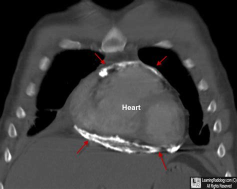 Learningradiology Pericardial Calcifications Constrictive Pericarditis