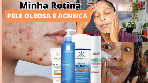 COMO CONTROLAR A OLEOSIDADE CLAREAR MANCHAS DE ACNE E DIMINUIR CRAVOS