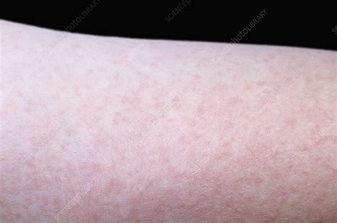 Measles rash on human skin - Stock Image - C005/4923 - Science Photo Library