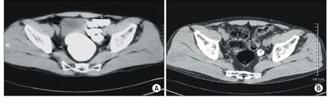 Figure 1 From Ureteral Obstruction Caused By Periureteral Tuberculous Granuloma After