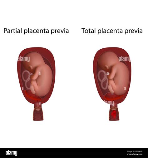 Placenta Accreta Diagram