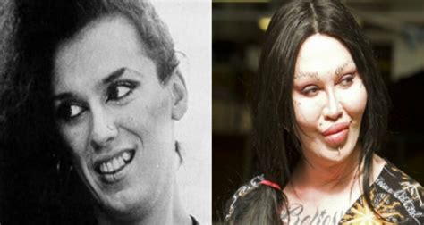 Pete Burns Before and After Lip Injections | Young Kennel