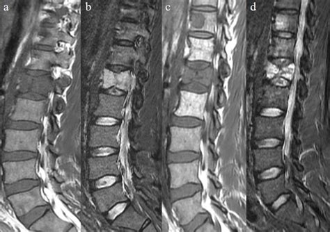 Baseline Spinal MRI A Sagittal T1 Weighted And B Sagittal STIR Images