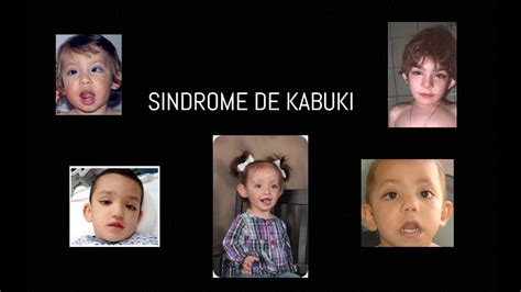 SINDROME DE KABUKI YouTube