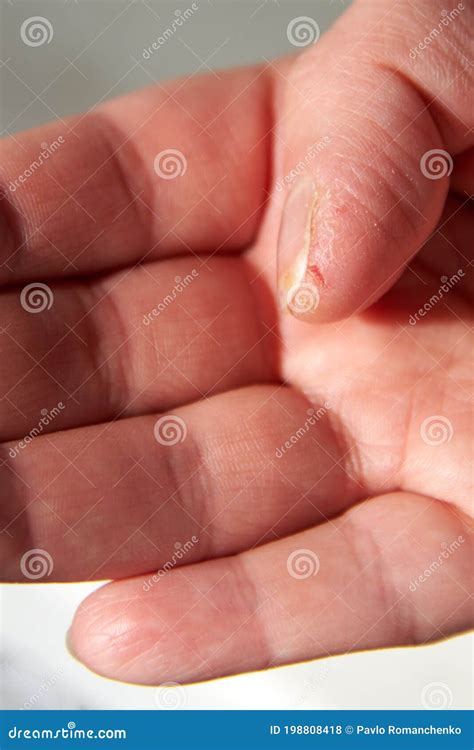 Cracked And Dry Skin On A Woman`s Thumb Close Up Stock Photo Image