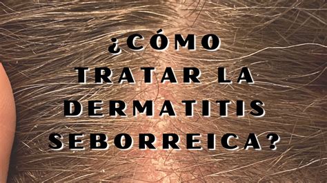 Manejo De Dermatitis Seborreica Dermatitis Seborreica