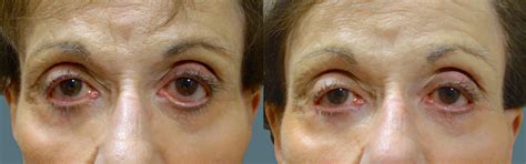 Ectropion After Lower Blepharoplasty