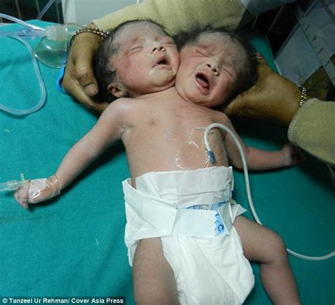 Indian Conjoined Twins Body Die At 20 Days Old Before Their Mother Met Them Daily Mail Online