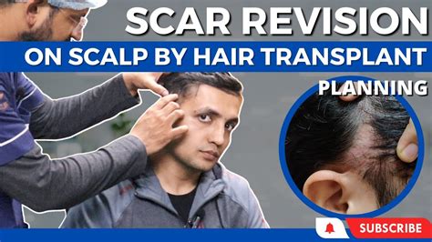 Scar Revision On The Scalp Result Scalp Scar Revision With Hair