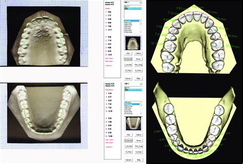 Measurement Of Mesiodistal Tooth Sizes Using The Digital Method And The