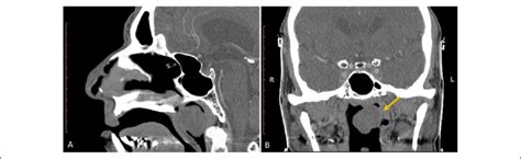 Computed Tomography Ct Images Showing The Tumor A Sagittal Section