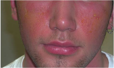 Figure 2 From Isotretinoin Systemic Therapy And The Shadow Cast Upon