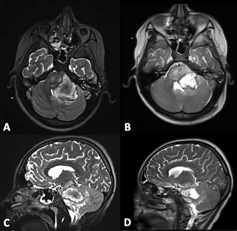 Preoperative Axial A And Sagittal C T2 Weighted MRI Demonstrating