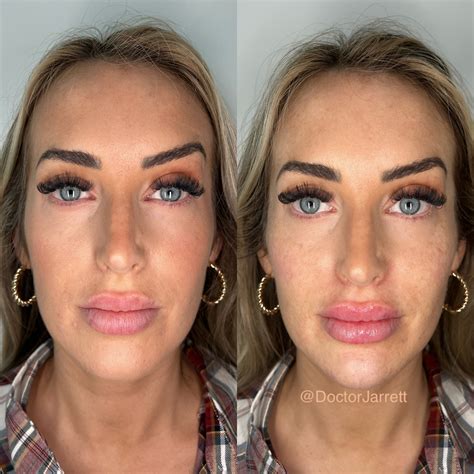 Facial Balancing Designer Aesthetics By Dr Jarrett Schanzer Miami